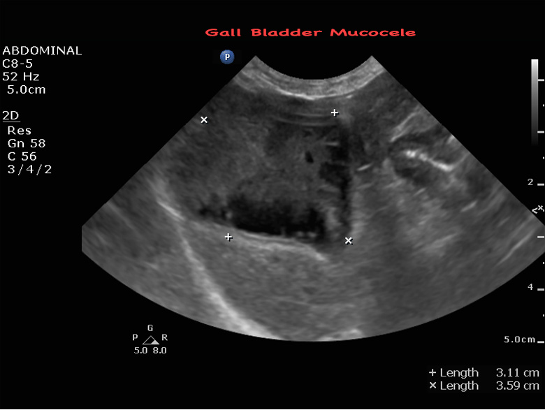 Gall Bladder Mucocele